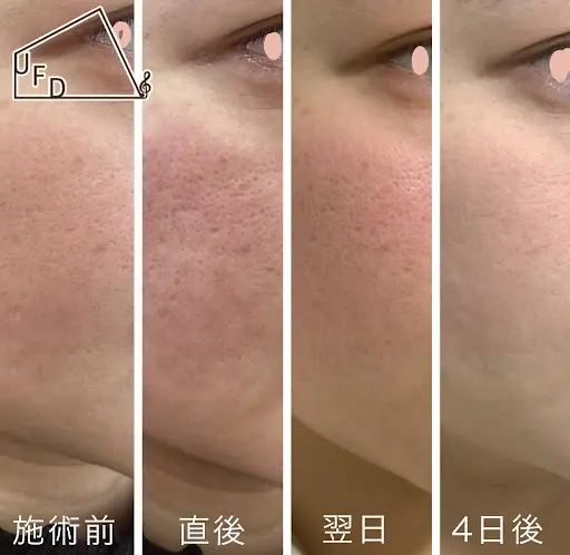 ポテンツァの症例