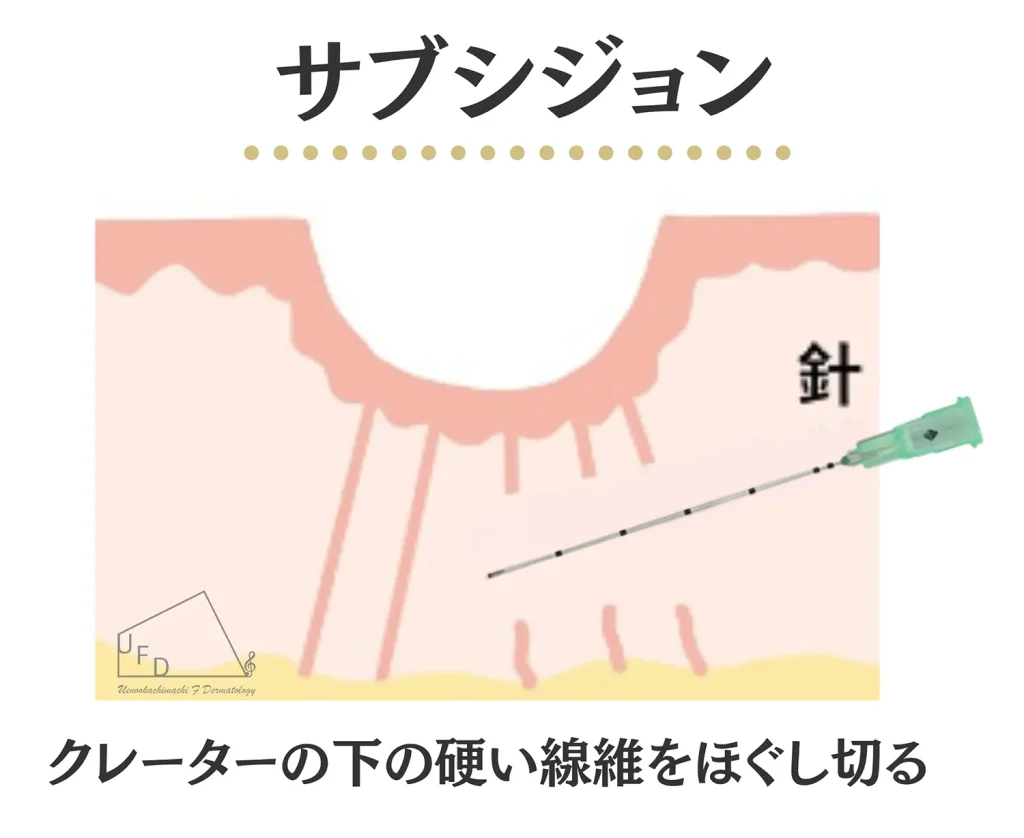 サブシジョンの構造
