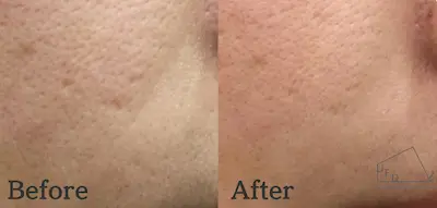 トライフィルプロ症例1