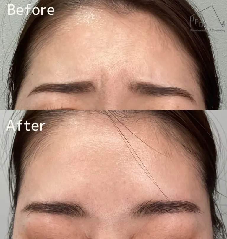 【20歳代女性】眉間のシワ症例