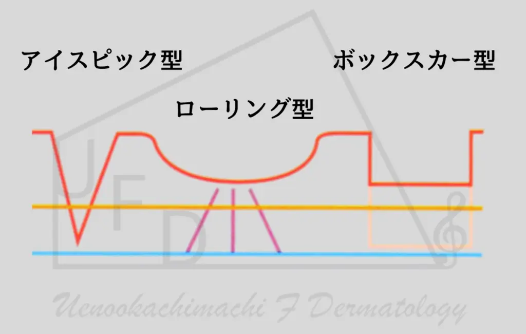 クレーター状になったニキビ跡の種類と特徴