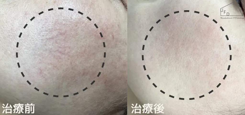 Vビームコラム症例1