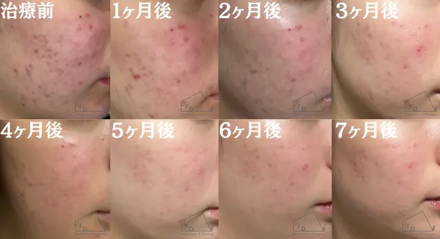 イソトレチノイン症例2