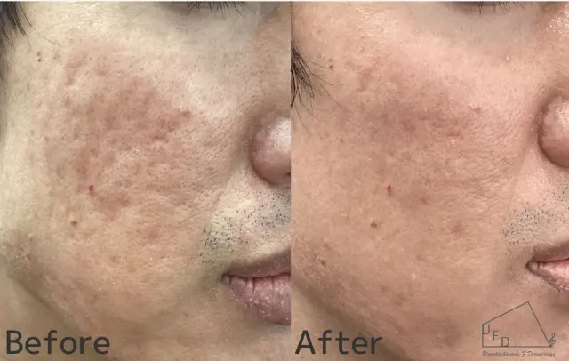 サブシジョンの症例1