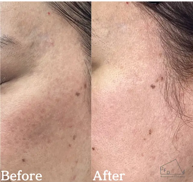 サブシジョンの症例2