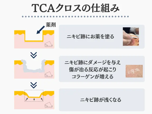 TCAの画像