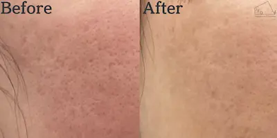 トライフィルプロ症例2