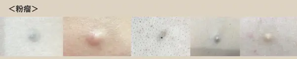 粉瘤一覧画像