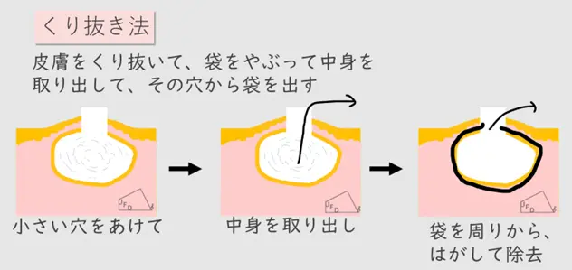 くり抜き法の説明画像