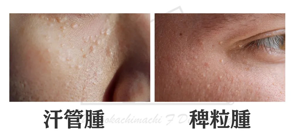 汗管腫と稗粒腫