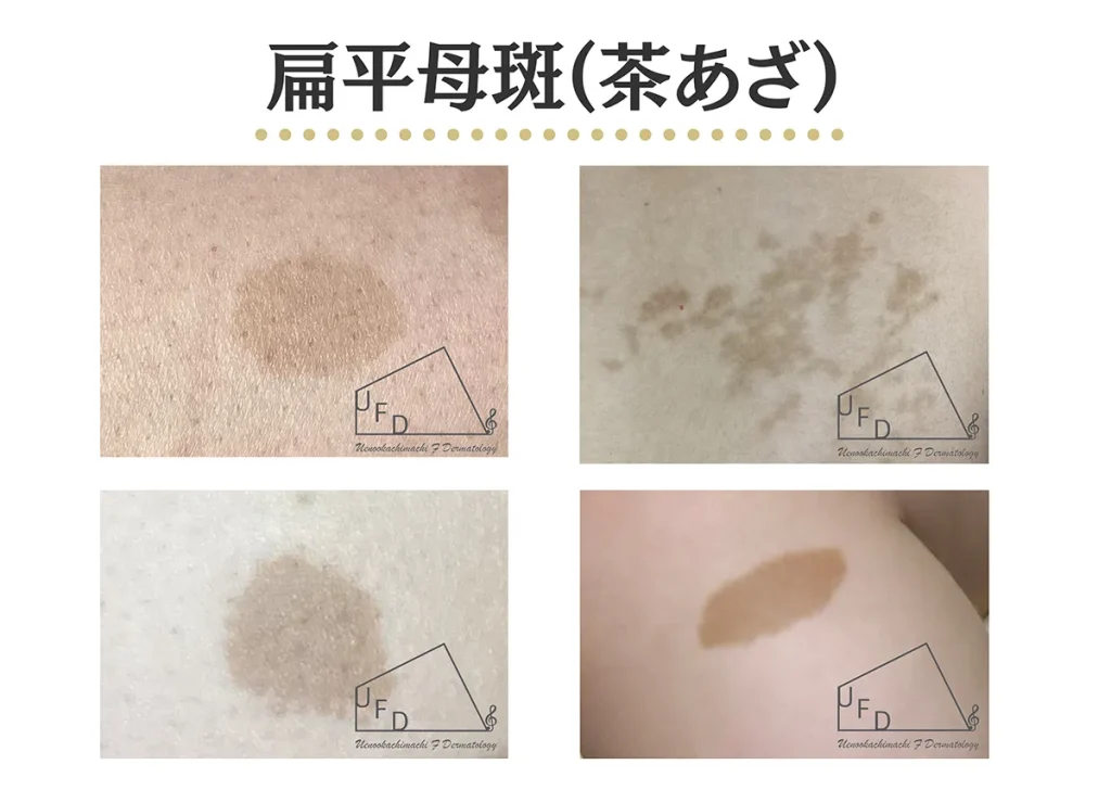 扁平母斑(茶あざ)