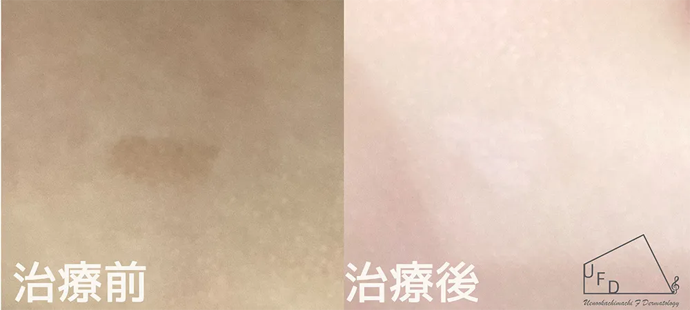 扁平母斑_症例_01