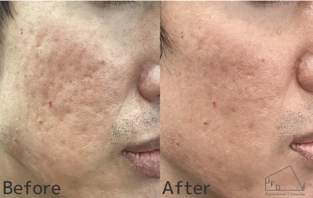 サブシジョン症例1