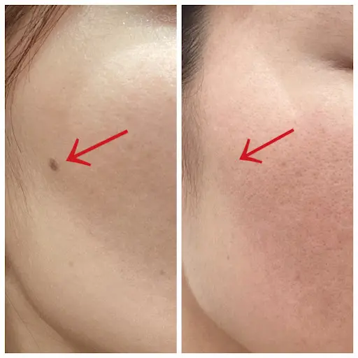 顔のほくろ画像