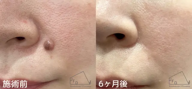 顔のほくろ画像