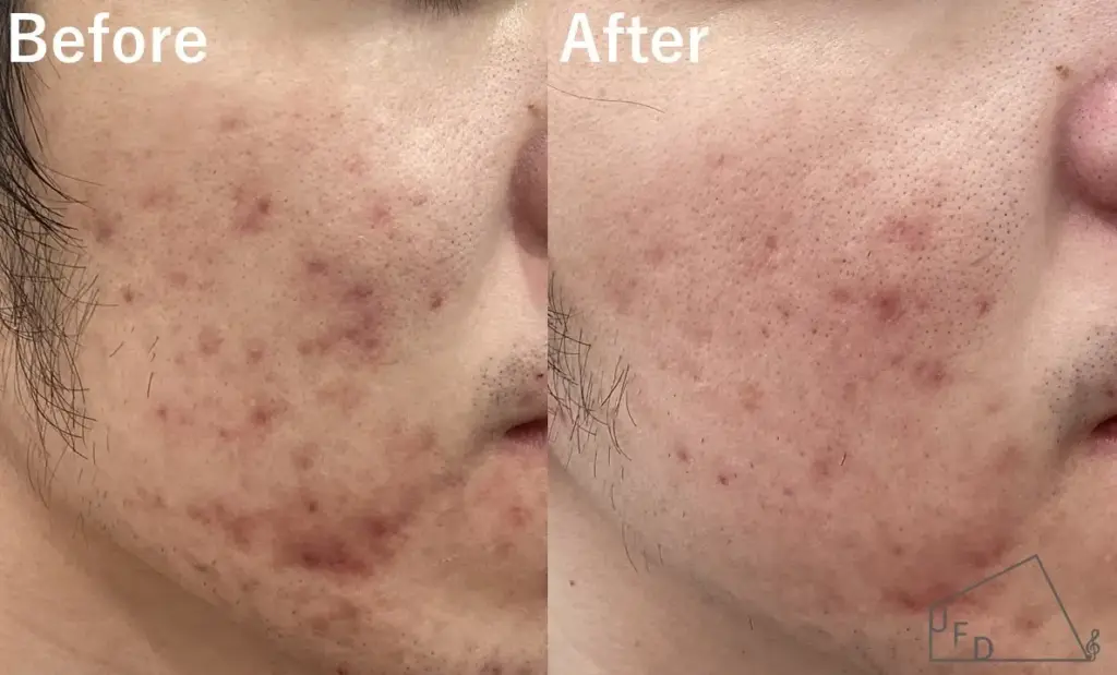 ポテンツァの症例1