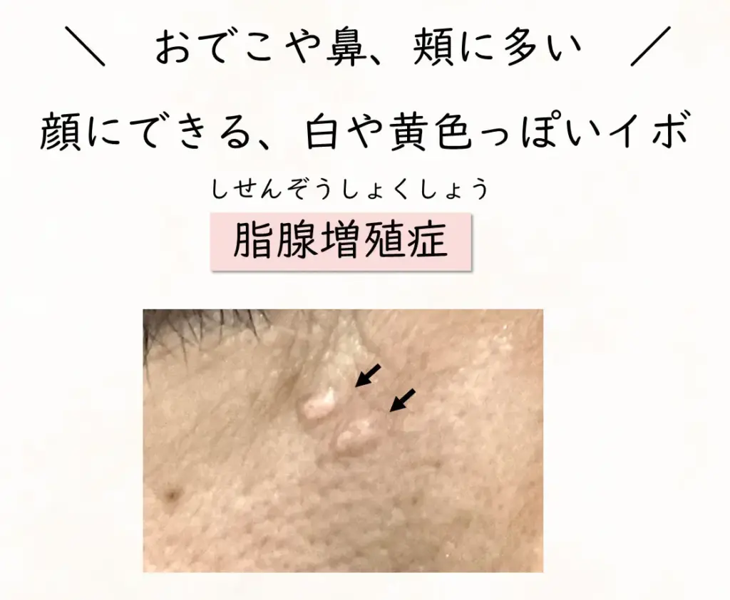 脂腺増殖症の説明