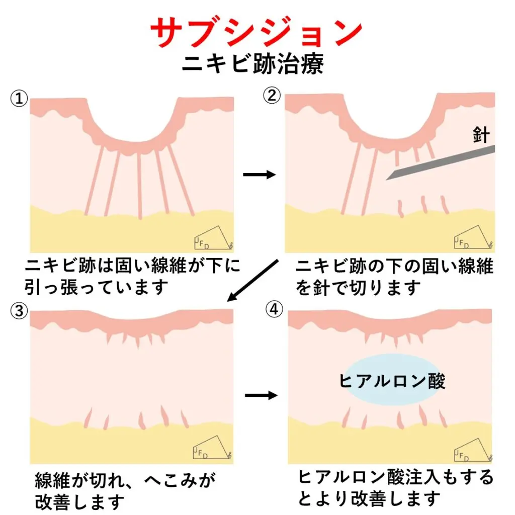サブシジョンの仕組み