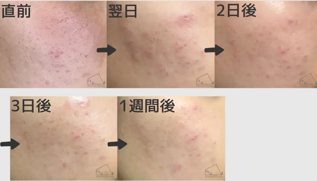 ダウンタイム症例