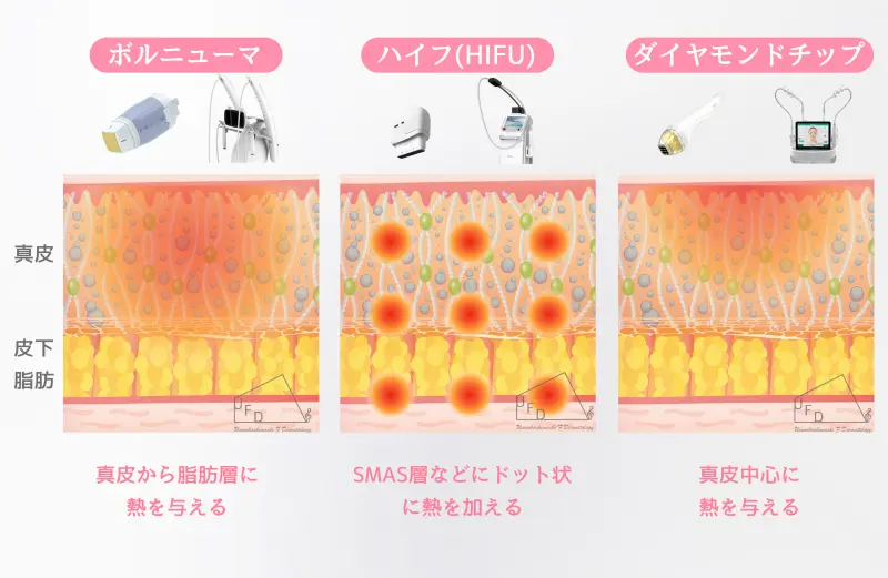 ボルニューマ、ハイフ(HIFU)、ポテンツァ(ダイヤモンドチップ)の効果イメージ図