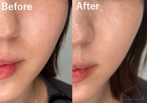 ジュベルックボリューム(レニスナ)の当院症例