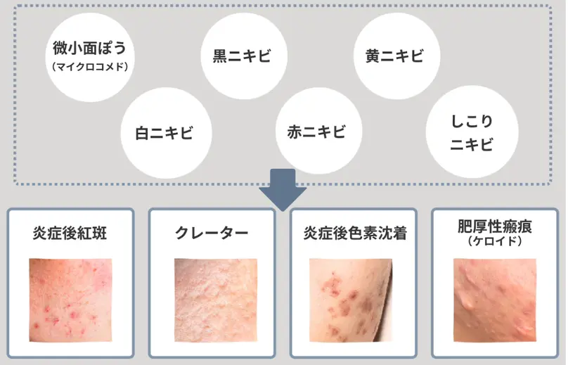 ニキビの種類の説明