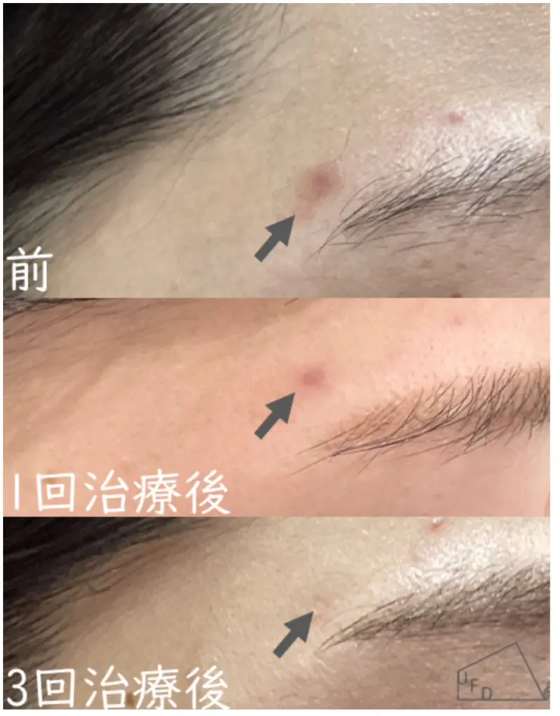当院の症例 【30歳代女性】左こめかみのニキビ跡の赤み（3回実施）