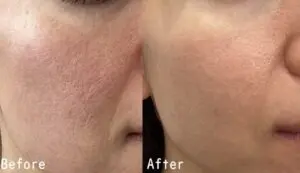 当院の症例 【30歳代女性】ニキビ跡・毛穴改善(3回実施)