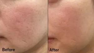 当院の症例 【30歳代女性】頬のニキビ跡(ポテンツァ(ニキビ跡モード)2回実施、サブシジョン1回)