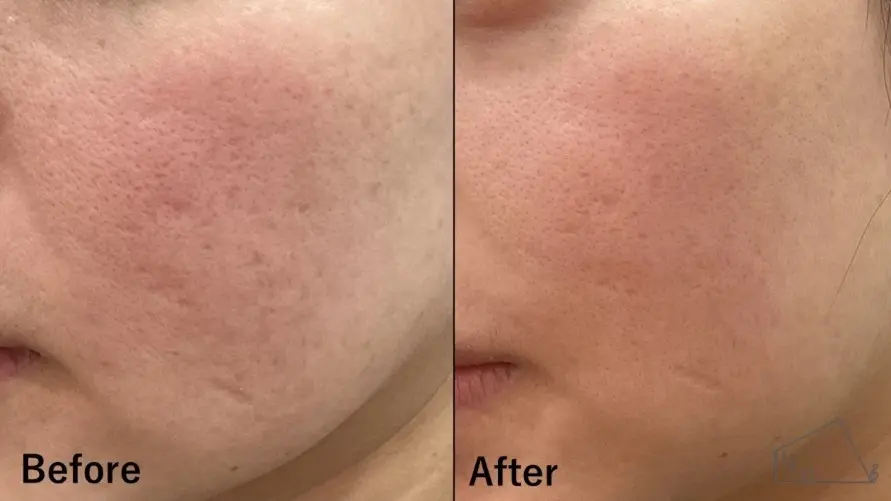 当院の症例 【30歳代女性】頬のニキビ跡（ポテンツァ（ニキビ跡モード）2回実施、サブシジョン1回）