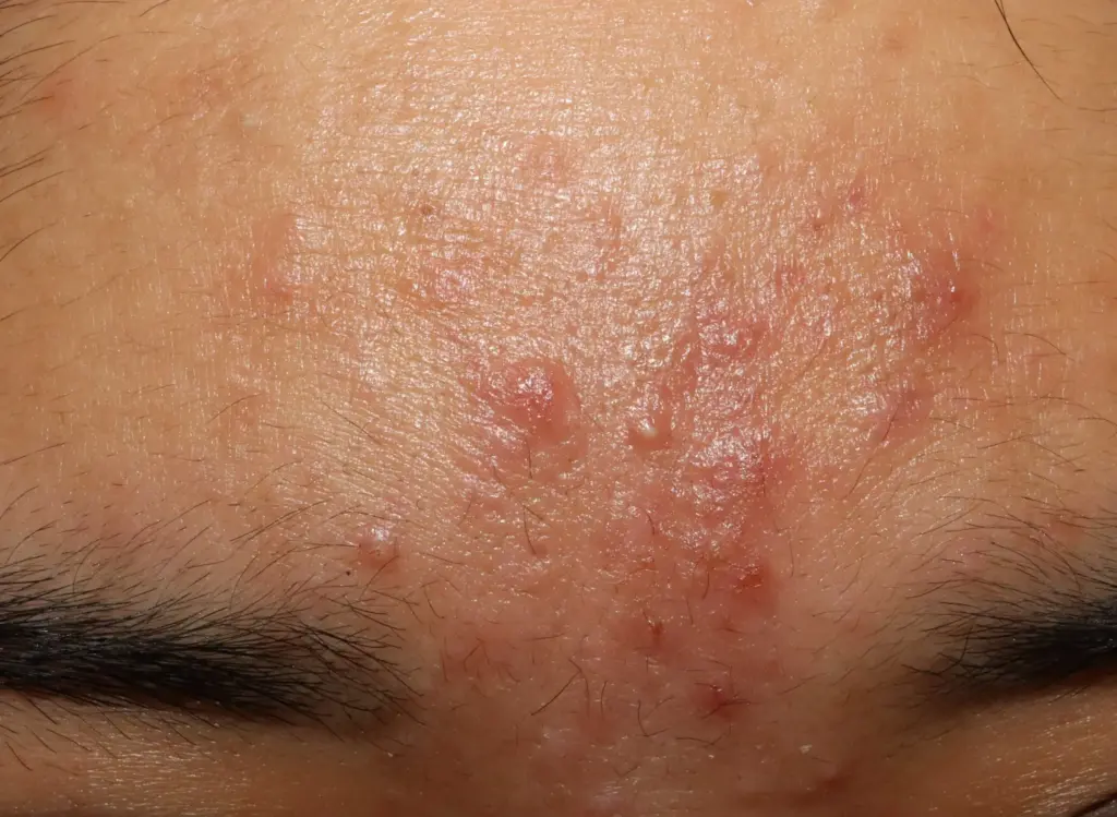 ニキビについて