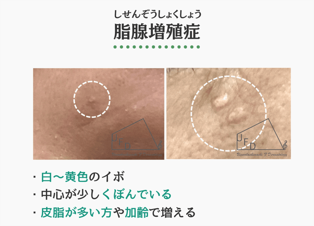 脂腺増殖症の症状写真 特徴や原因 治療法について解説