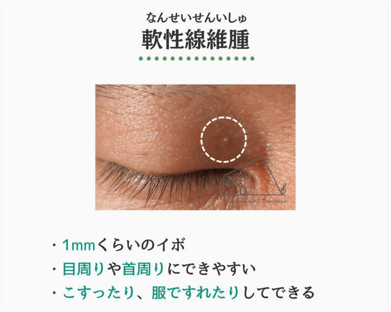 軟性線維腫の症状写真 特徴や原因 治療法について解説