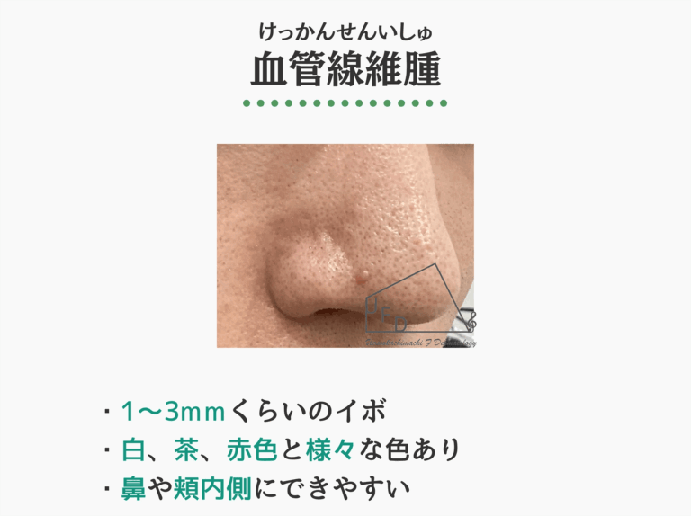 血管線維腫の症状写真 特徴や原因 治療法について解説