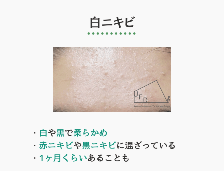 白ニキビの症状写真 特徴や原因 治療法について解説