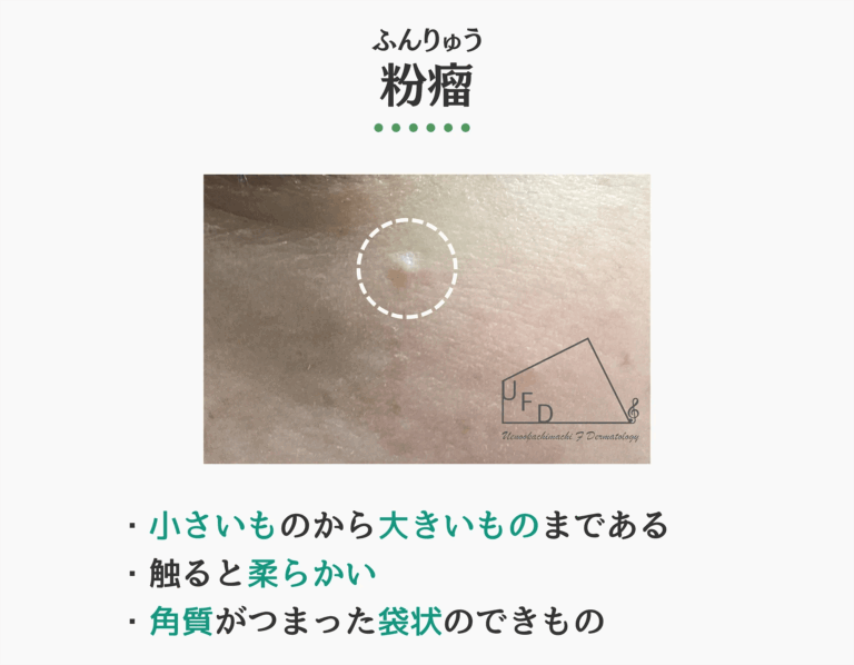 粉瘤の症状写真 特徴や原因 治療法について解説