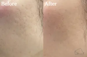 当院の症例【30代女性】左頬のニキビ跡（サブシジョン1回実施）