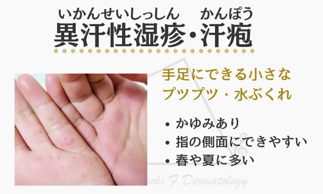 異汗性湿疹(いかんせいしっしん),汗疱(かんぽう)画像01