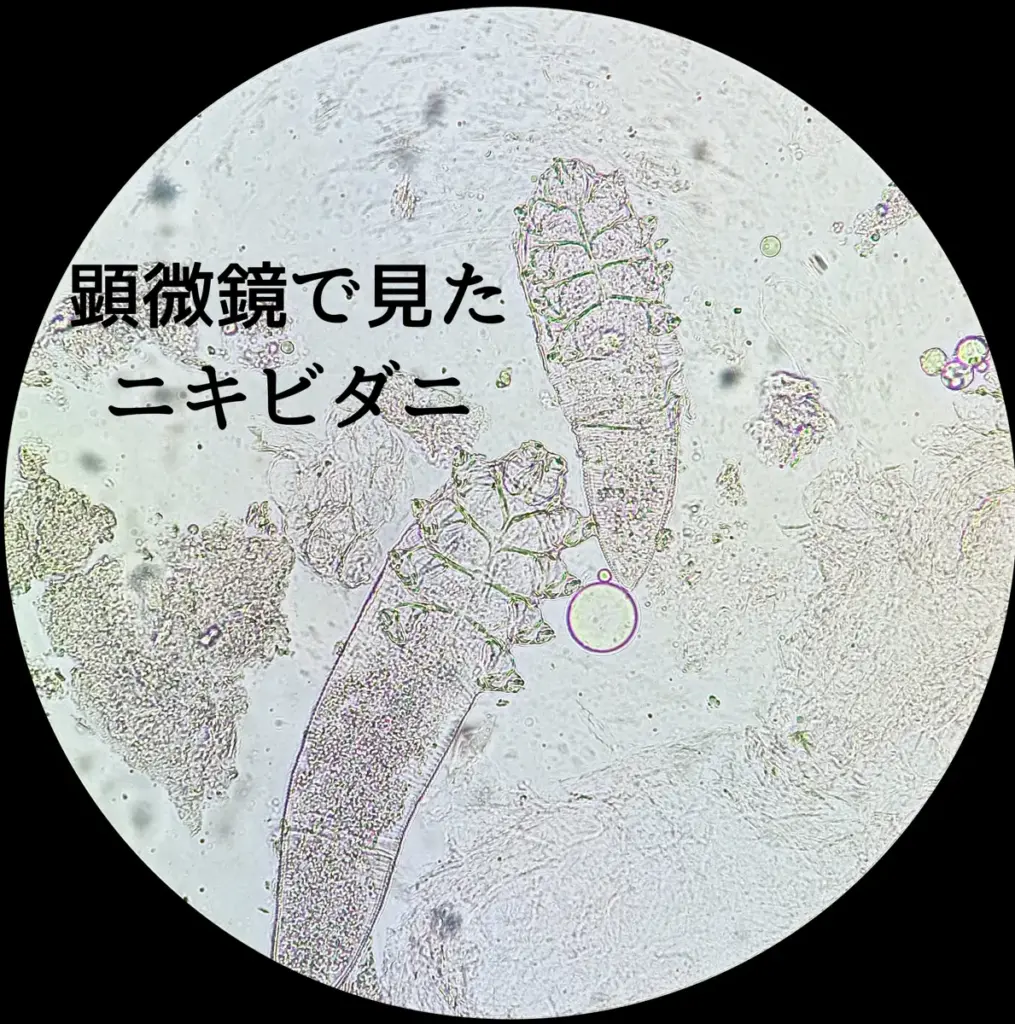 画像:ニキビダニ