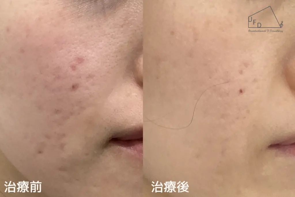 トライフィルプロ症例4 【30歳代女性】頬のニキビ跡(2回実施)