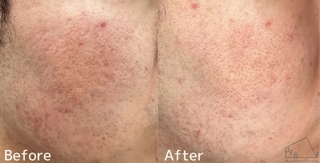 ポテンツァニキビ跡治療症例3