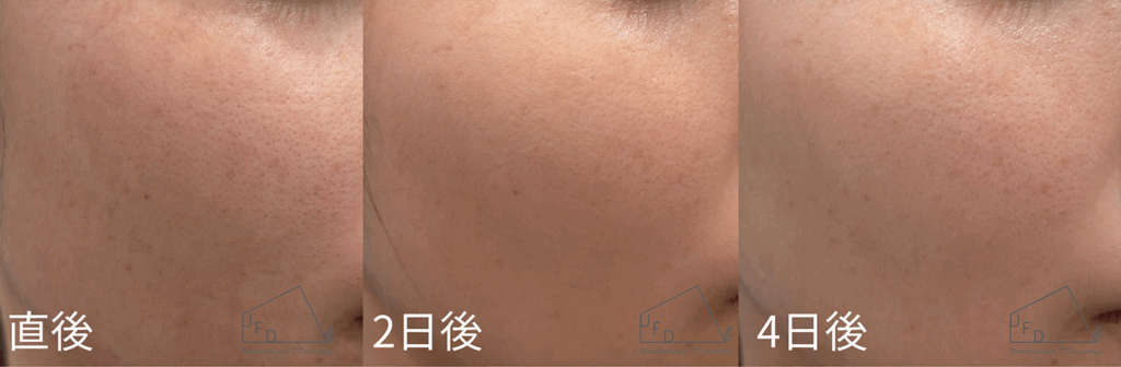 blessingのダウンタイム症例について紹介。症例1