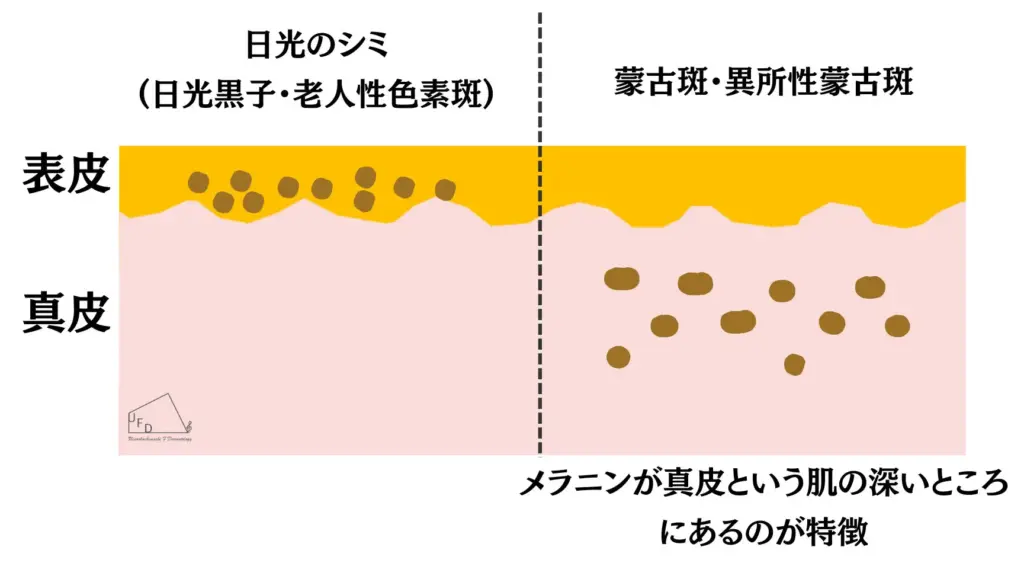 異所性蒙古斑の原因