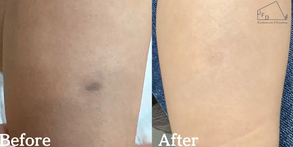 右下腿の異所性蒙古斑