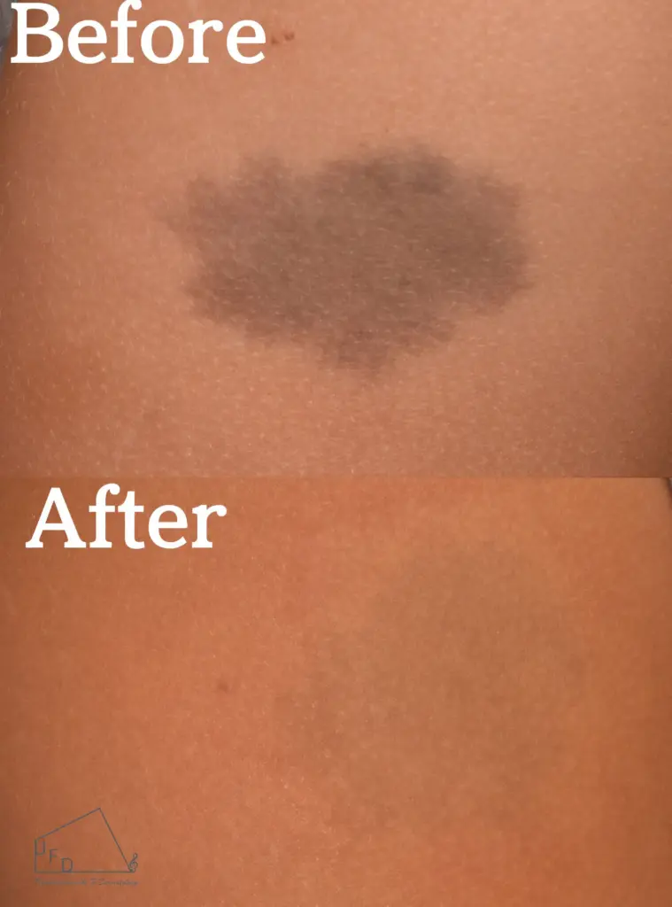 右上腕の異所性蒙古斑