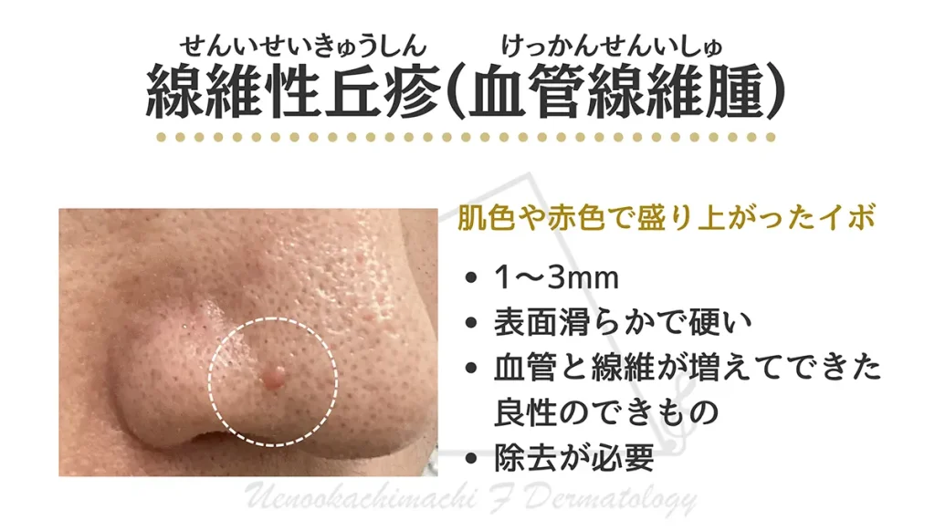 鼻のイボ(線維性丘疹)とは