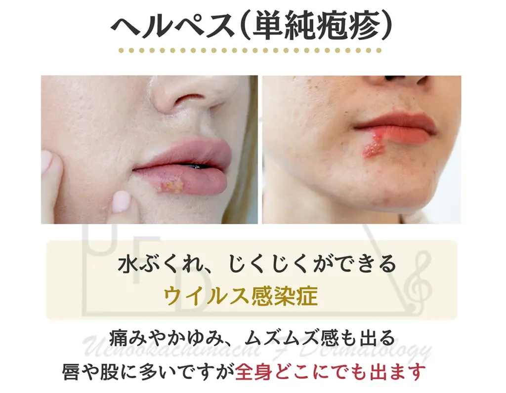 ヘルペス 単純疱疹