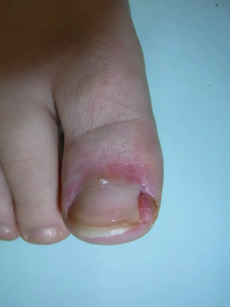 陥入爪(かんにゅうそう