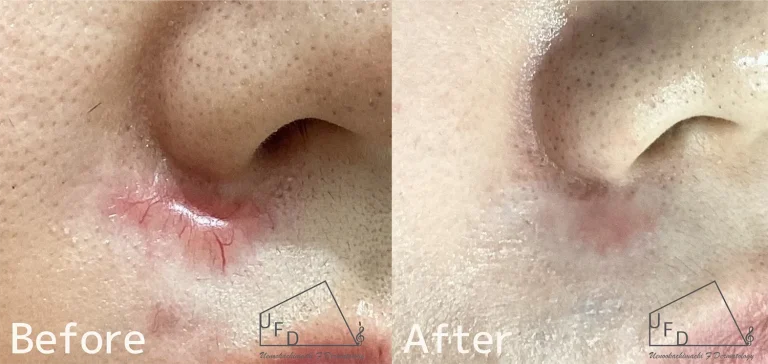 ケロイドと肥厚性瘢痕の治療症例について紹介１