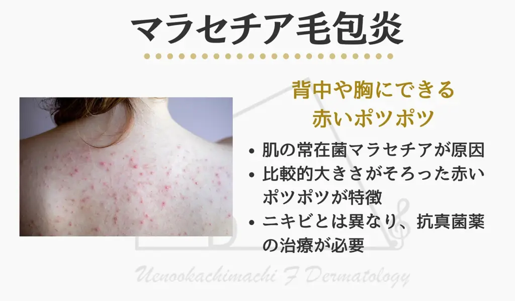 背中や胸にできるニキビのようなマラセチア毛包炎